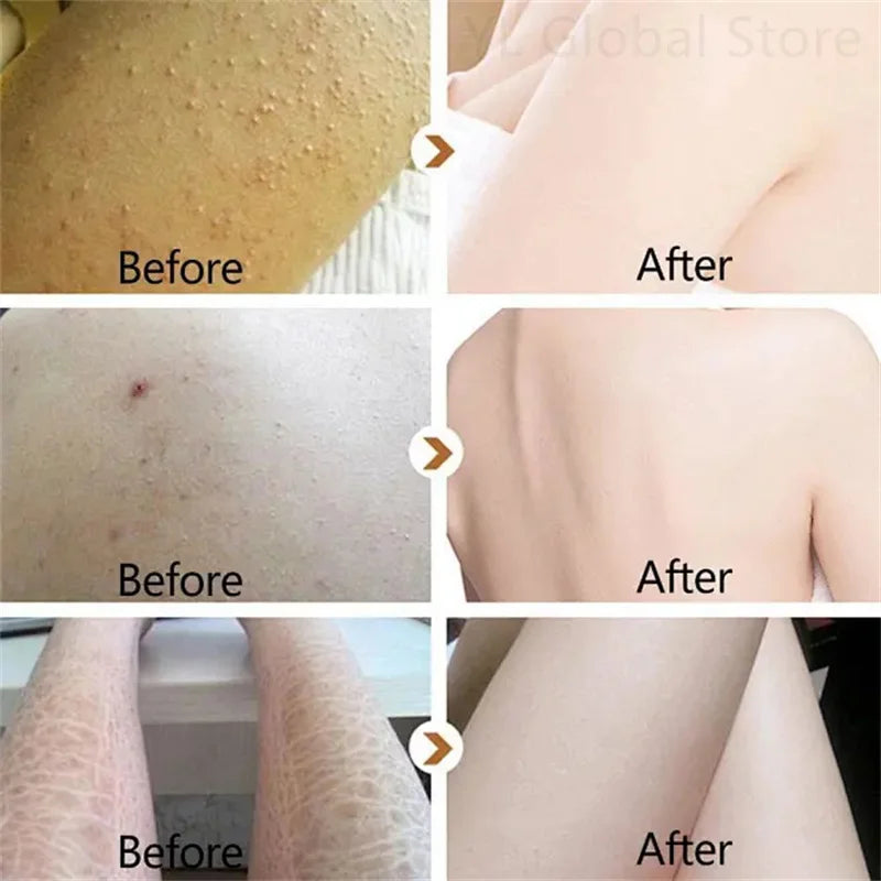 Fruit Acid VE Urea Cream Improve Chicken Skin Keratosis Pilaris Hydrating Moisturizing Rejuvenating Body Lotion Leg Arm Dry Skin