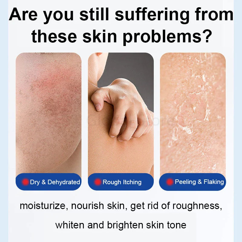 Fruit Acid VE Urea Cream Improve Chicken Skin Keratosis Pilaris Hydrating Moisturizing Rejuvenating Body Lotion Leg Arm Dry Skin