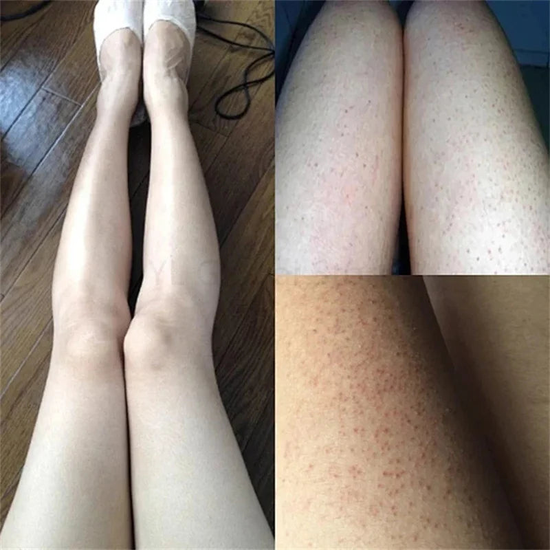 Fruit Acid VE Urea Cream Improve Chicken Skin Keratosis Pilaris Hydrating Moisturizing Rejuvenating Body Lotion Leg Arm Dry Skin