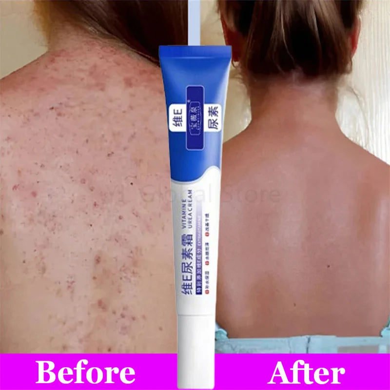 Fruit Acid VE Urea Cream Improve Chicken Skin Keratosis Pilaris Hydrating Moisturizing Rejuvenating Body Lotion Leg Arm Dry Skin