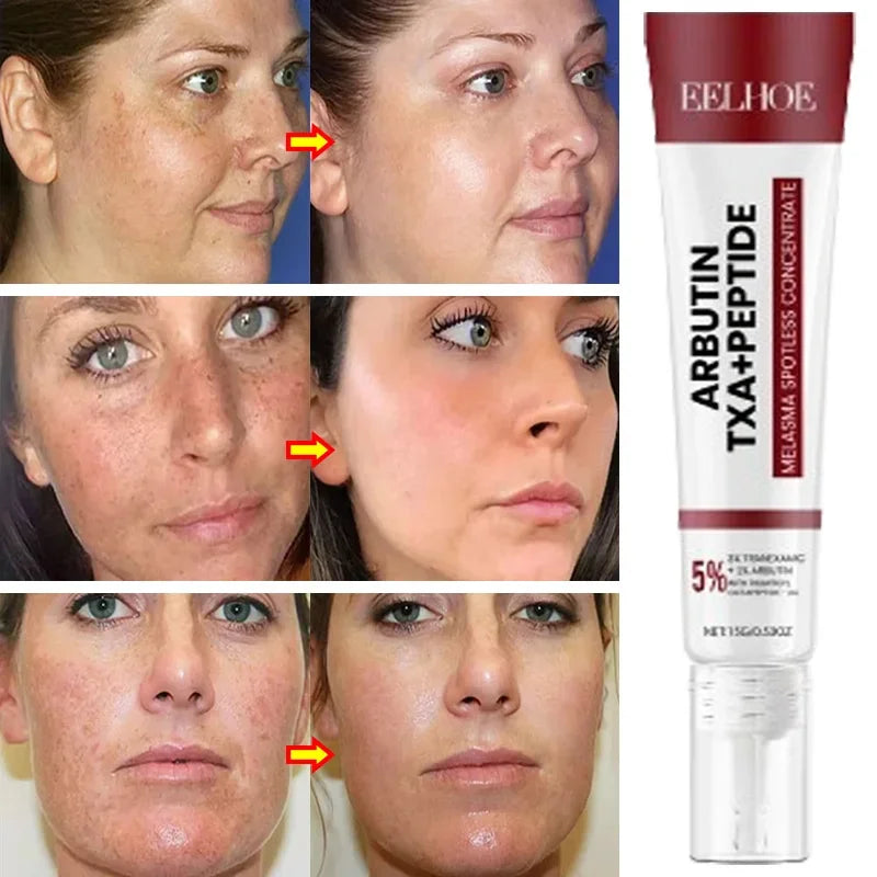 Powerful Spot-Removing Whiten Cream Brighten Skin Fast Eliminates Melanin Pigmentation Melasma Dark Spots Korean Skin Care 20g