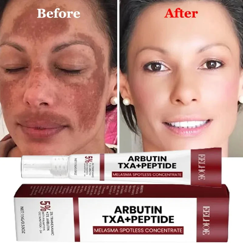Powerful Spot-Removing Whiten Cream Brighten Skin Fast Eliminates Melanin Pigmentation Melasma Dark Spots Korean Skin Care 20g